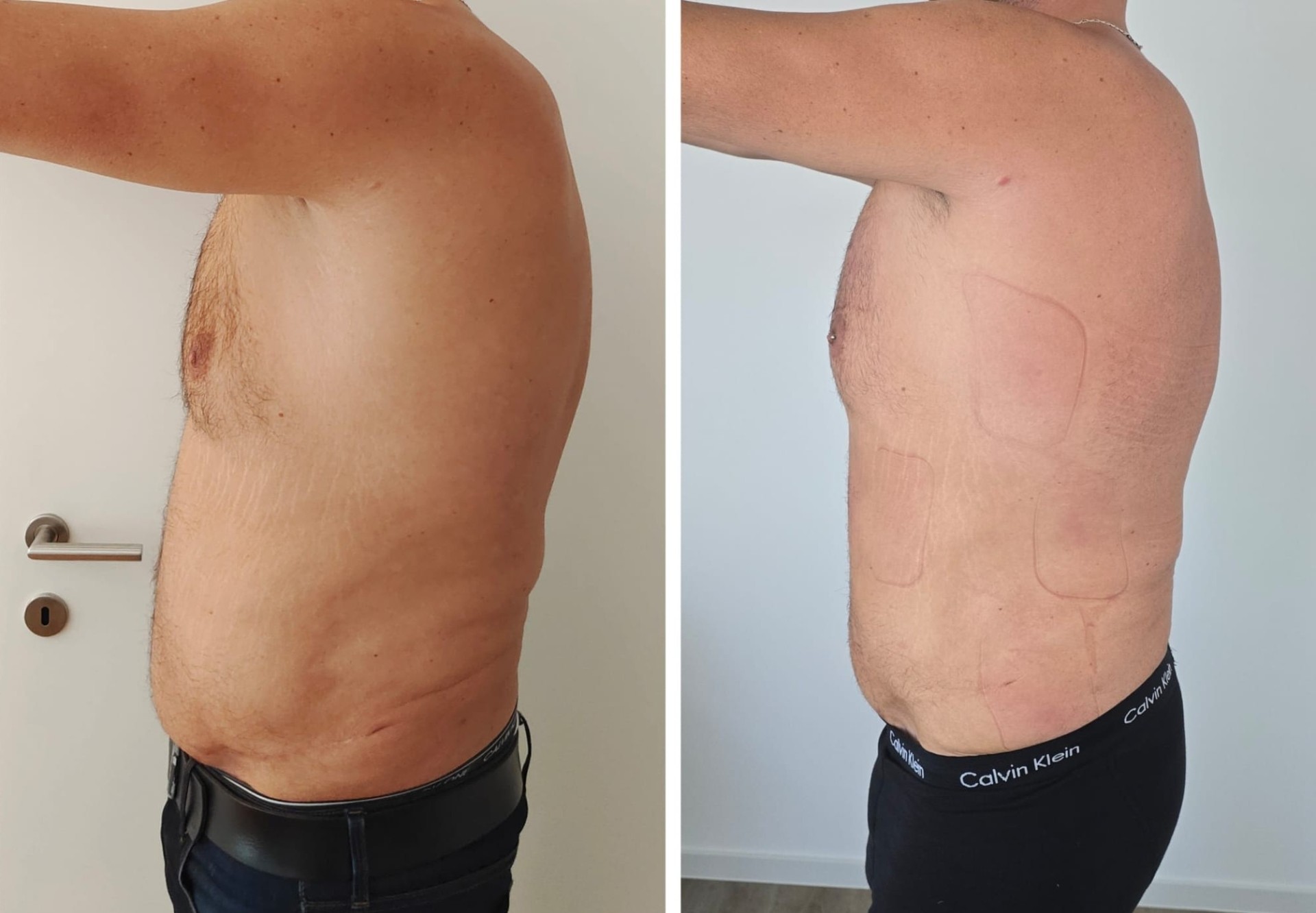 Vorher Nachher Ergebnis 9: Seitenprofil: flacherer Bauch