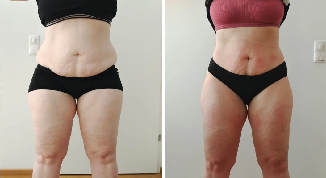 Vorher-Nachher Ergebnis Cellulite an Oberschenkeln