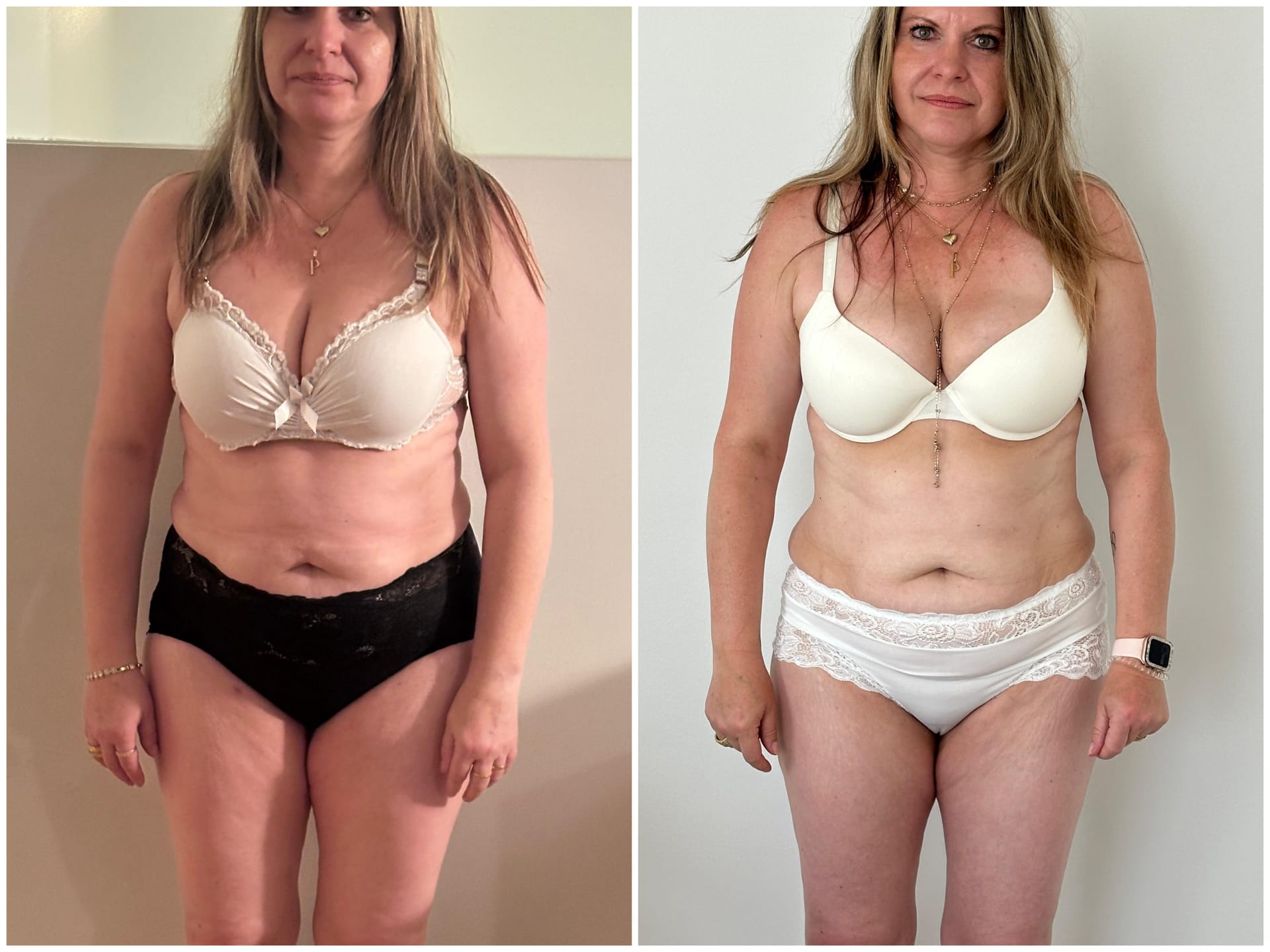 Vorher Nachher Ergebnis 1: Bauch & Taille: sichtbar definierter